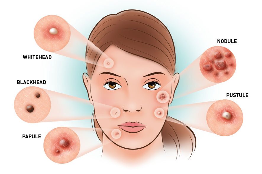 5 jenis jerawat di muka dan tips untuk atasinya