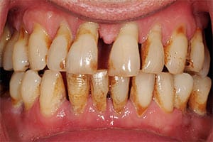 advanced periodontal disease