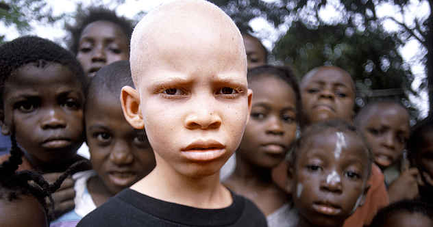 albino afrika