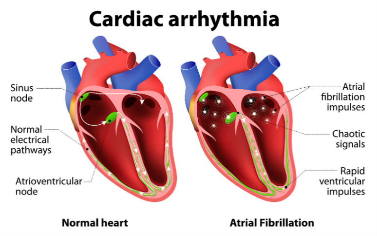 arrhythmia home remedy