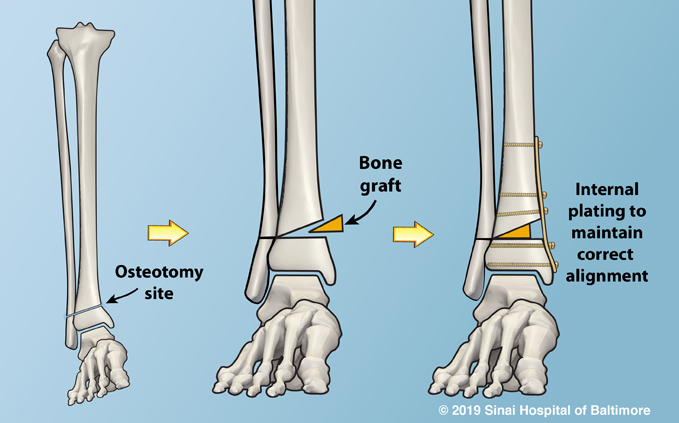 art tx plate tibia