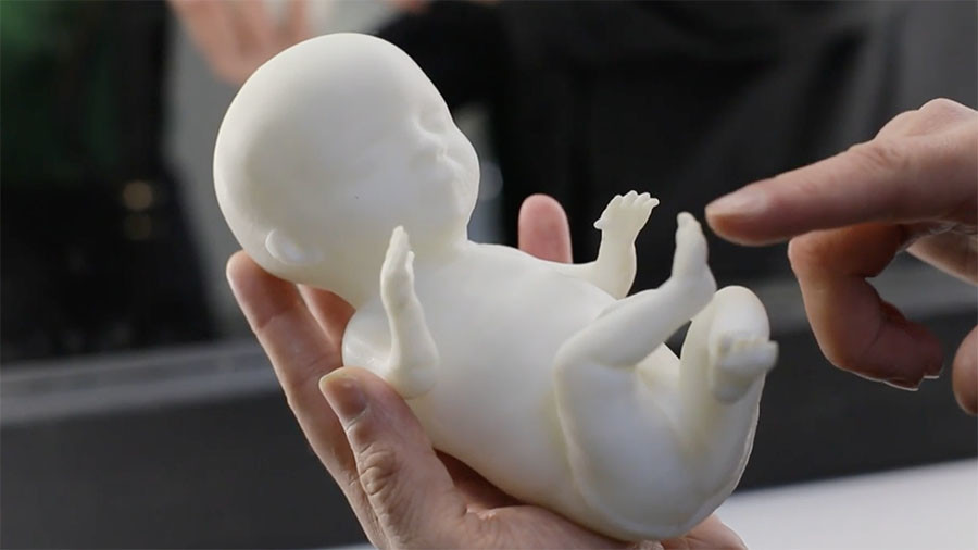 bakal ibu bapa boleh mengetahui rupa anak sebenar menggunakan percetakan 3d berbentuk fetus janin 3