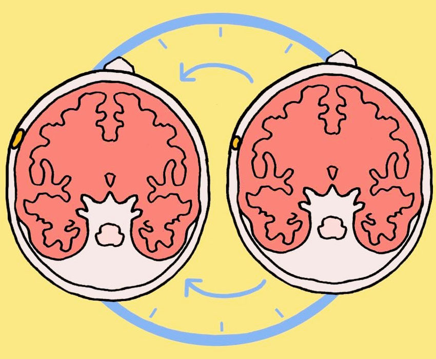 benign meningioma ketumbuhan otak paling kerap berlaku 2