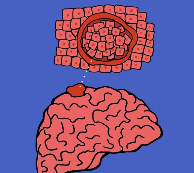 benign meningioma ketumbuhan otak paling kerap berlaku 3