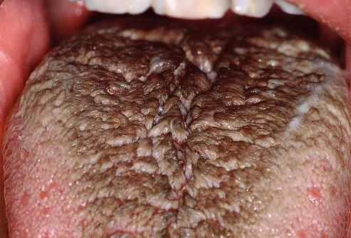 black hairy tongue