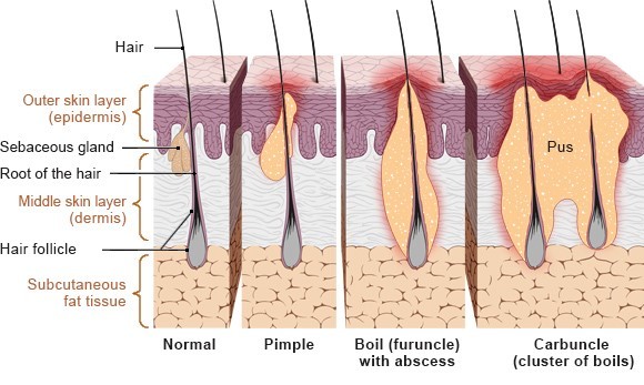 carbuncle pekung