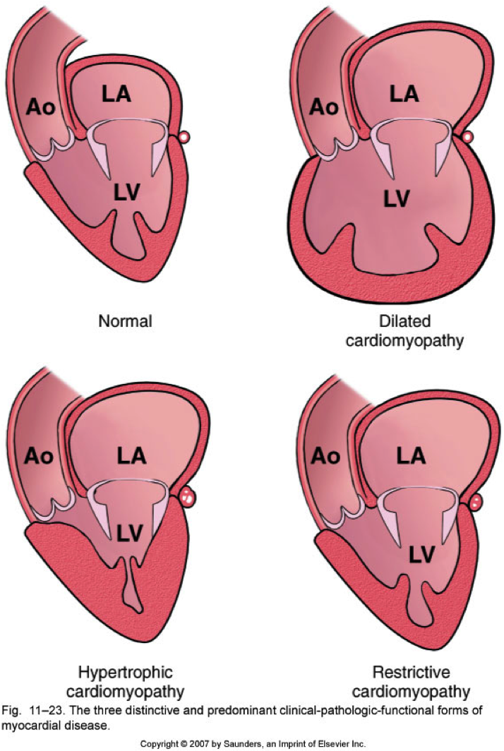 cardiomyopathy1332529933423