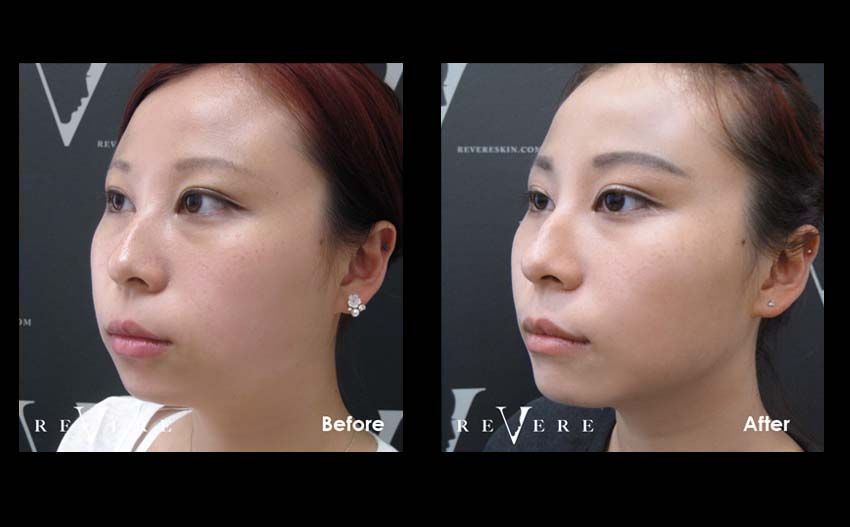 chubby cheek surgery