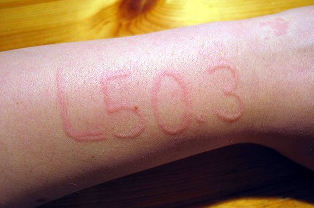 dermatographic urticaria