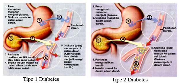 diabetes