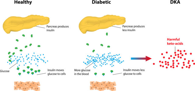 diabetic ketoacidosis