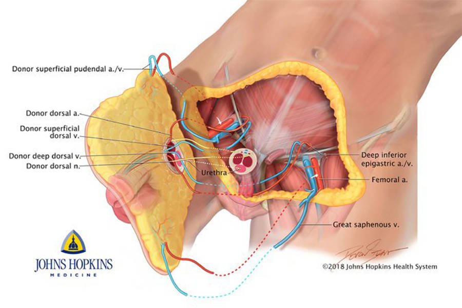 diagram daripada hospital john hopkins menunjukkan bagaimana pemindahan zakar berfungsi 813