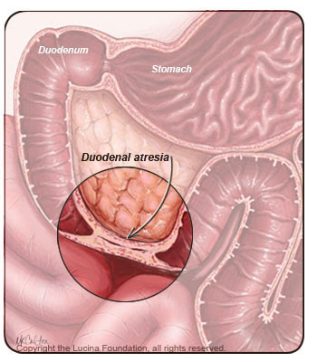 duodenal atresia