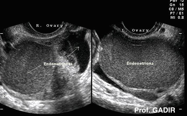 endometriomas di kedua dua ovari