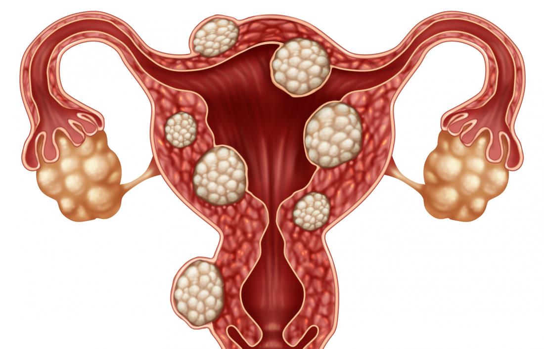 fibroids