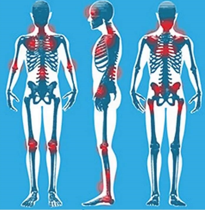 fibromyalgia 8 penyakit kronik yang mampu dirawat oleh ganja