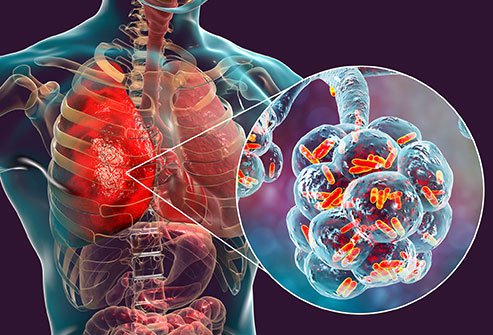 gambaran bakteria sesak nafas covid 19 corona virus