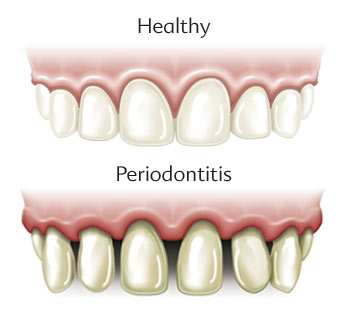 gum disease