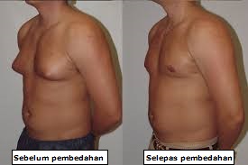 gynecomastia 942