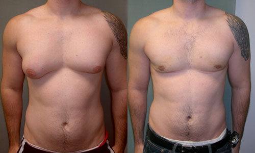 gynecomastia