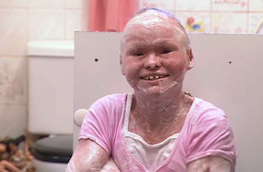 hannah betts penghidap harlequin ichthyosis