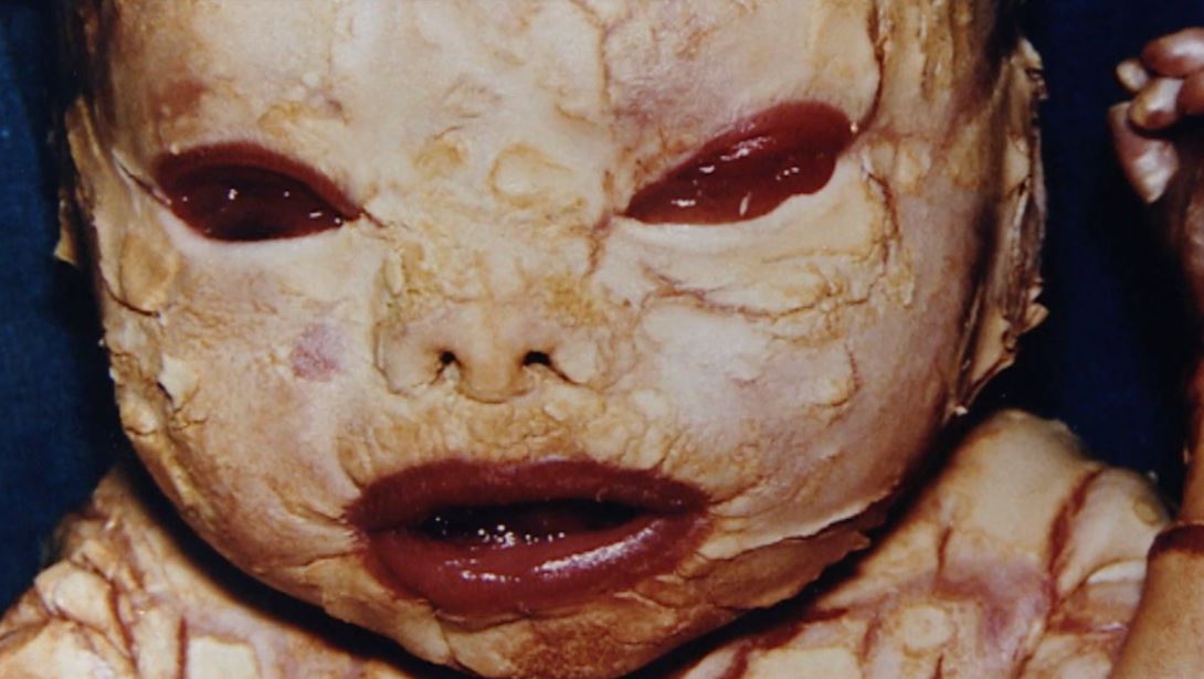 harlequin ichthyosis penyakit kulit genetik dahsyat yang boleh membunuh 2