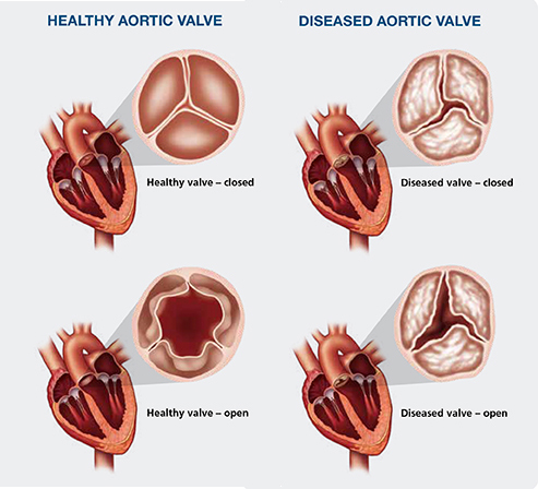 heartvalves