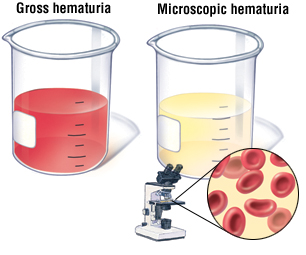 hematuria