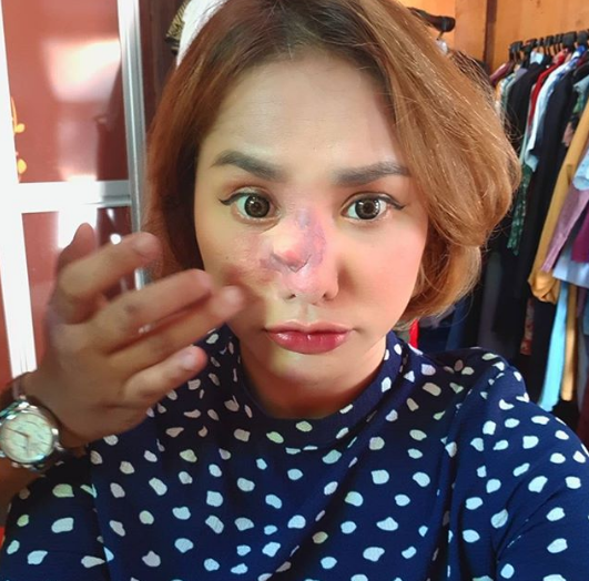 hidung elly mazlein dapat ketumbuhan 3