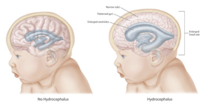 hydrocephalus