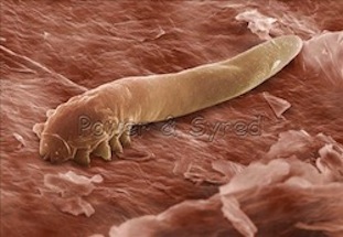 iluminasi demodex kutu wajah4 924