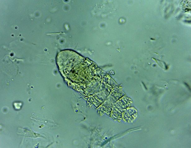 iluminasi demodex kutu wajah6