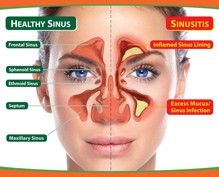 jangkitan sinus sinusitis