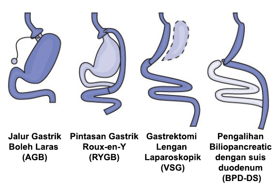jenis jenis pembedahan bariatrik