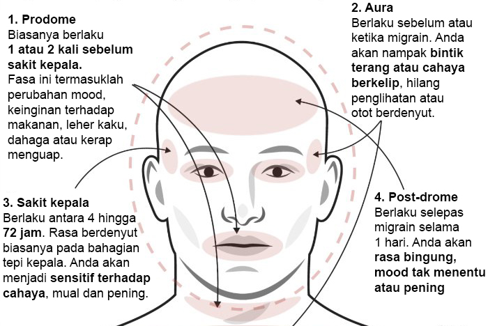 jenis jenis sakit kepala dan cara mengubatinya 3