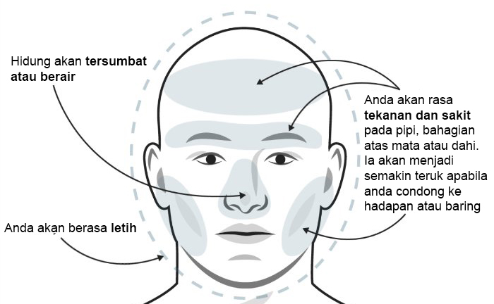 jenis jenis sakit kepala dan cara mengubatinya