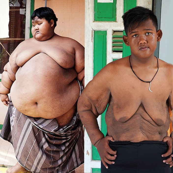 kanak kanak paling gemuk di dunia turun 100kg berat badan