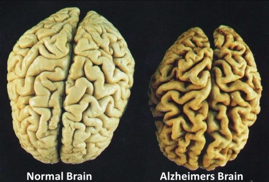 kelebihan berpuasa alzheimer