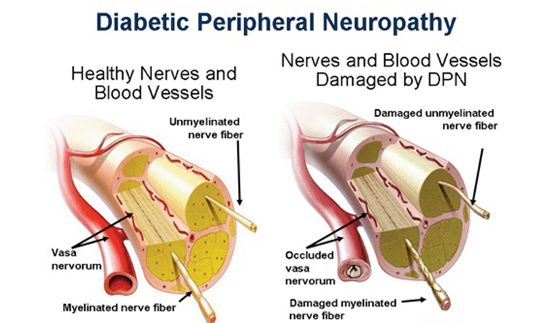 kesan arsenik terhadap kesihatan neuropati periferal 656