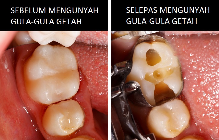 kesan kunyah gula gula getah