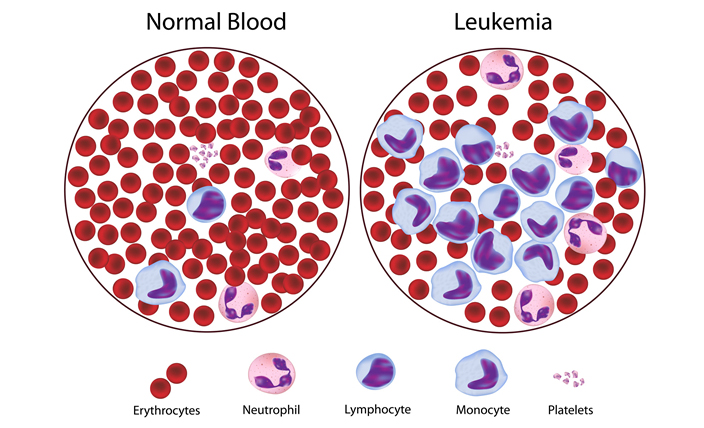 kesan nitrat dalam air masak kepada kesihatan leukemia