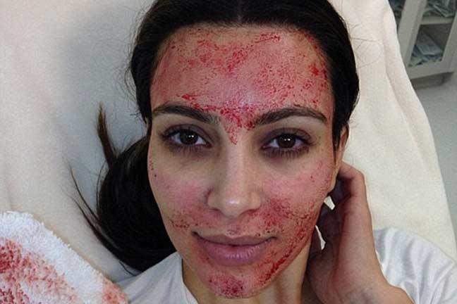 kim kardashian pengamal rawatan kecantikan vampire facelift