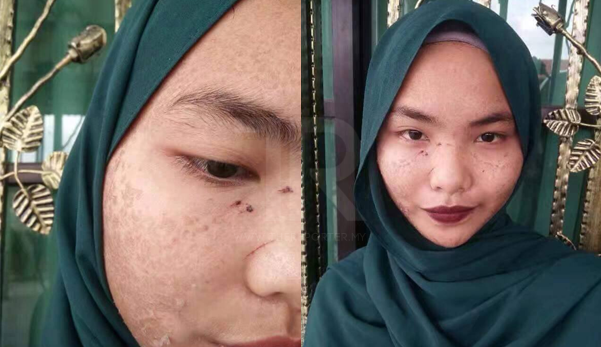 kulit bersisik kerana produk putih kulit krim kosmetik