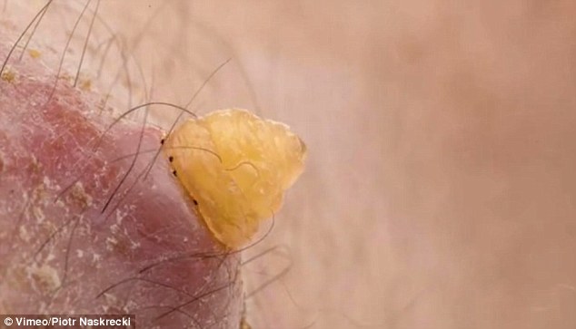 larva keluar daripada kulit 1