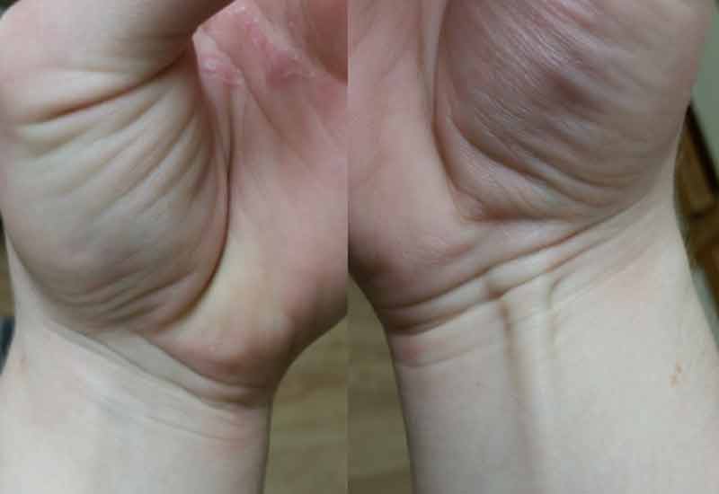 longus palmaris otot tangan