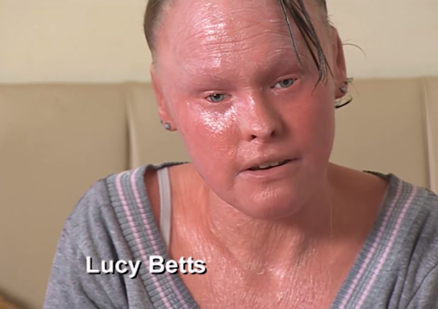 lucy betts penghidap harlequin ichthyosis 19