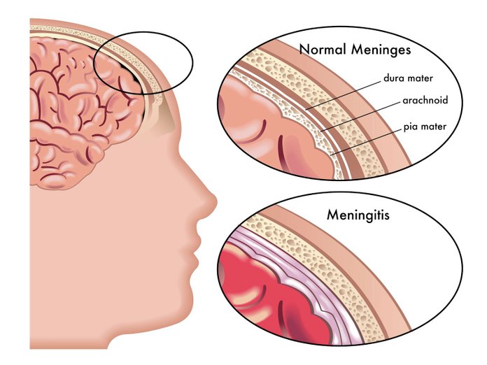 meningitis