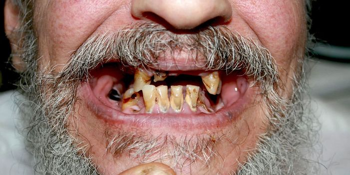 meth mouth disease