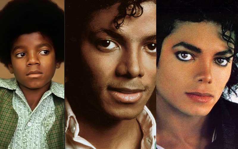 michael jackson penyakit kulit vitiligo