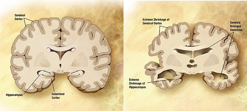 neurodegenerasi